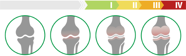 Stades cliniques de l'arthrose du genou (degré d'arthrose du genou)