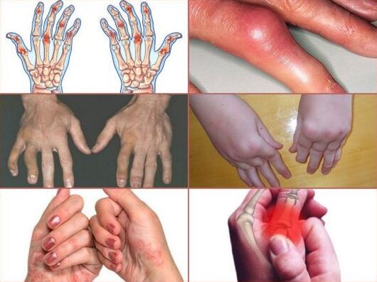 douleurs articulaires aux doigts