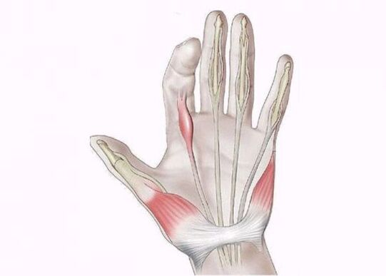 inflammation des tendons comme cause de douleurs articulaires des doigts
