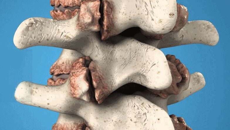 les ostéophytes de la colonne vertébrale comme cause de lombalgie