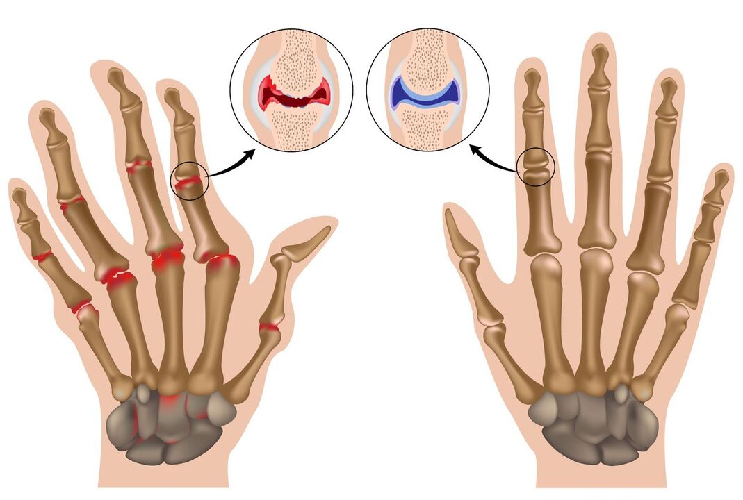 Articulations des mains saines et de celles atteintes de polyarthrite