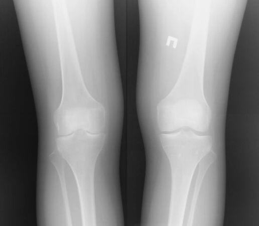 La radiographie conjointe du genou