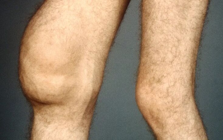 Post-trotrose de l'articulation du genou
