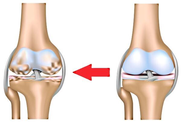 Articulation saine et arthrose