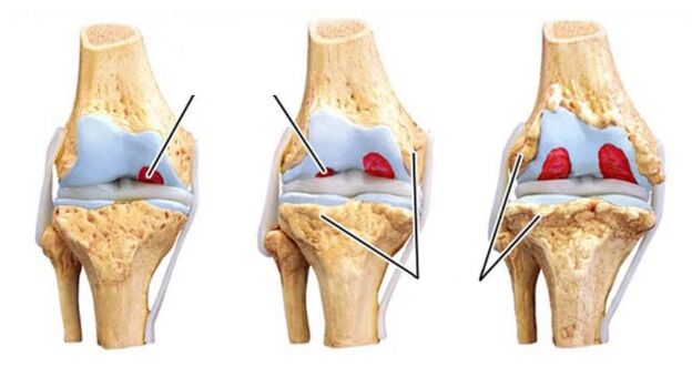 Complications des articulations arthrites