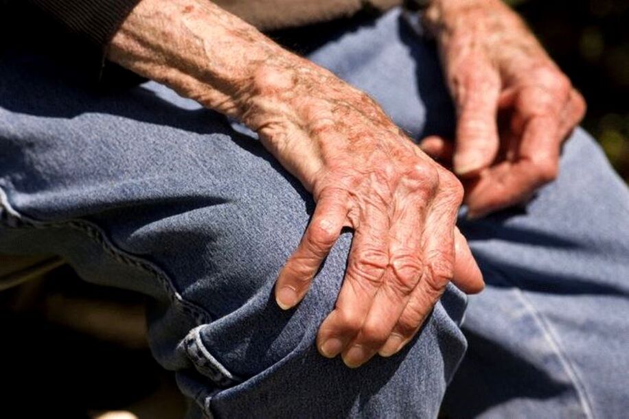 L'arthrose est une maladie liée à l'âge qui survient chez les personnes âgées.