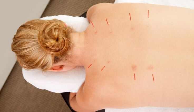 L'acupuncture pour l'ostéochondrose thoracique, qui présente de nombreux avantages.